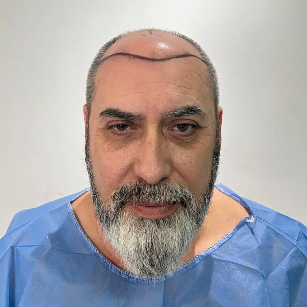 Paciente antes del implante capilar