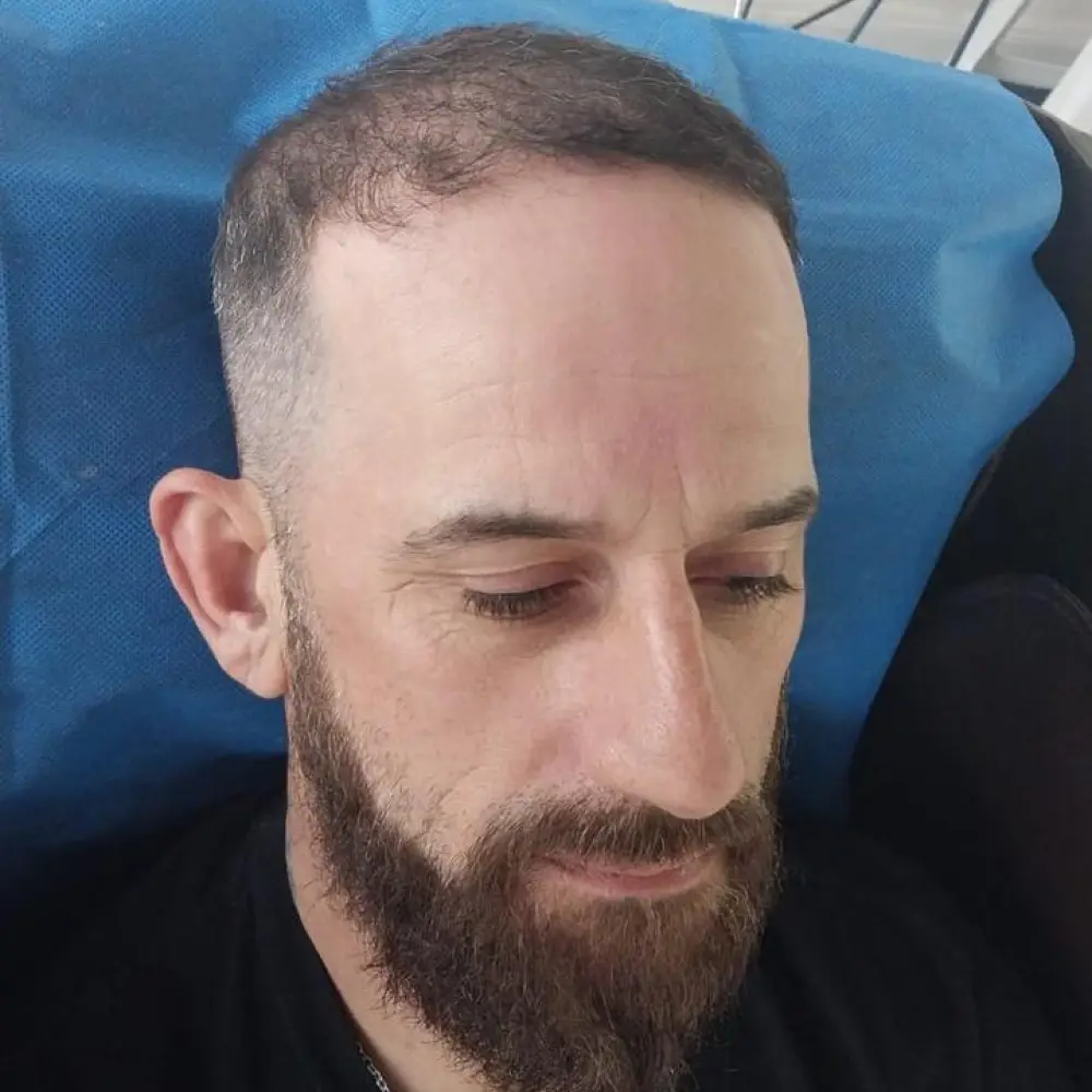 Paciente después del implante capilar