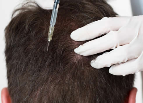 Especialista con guantes blancos aplicando inyección de mesoterapia capilar en el cuero cabelludo