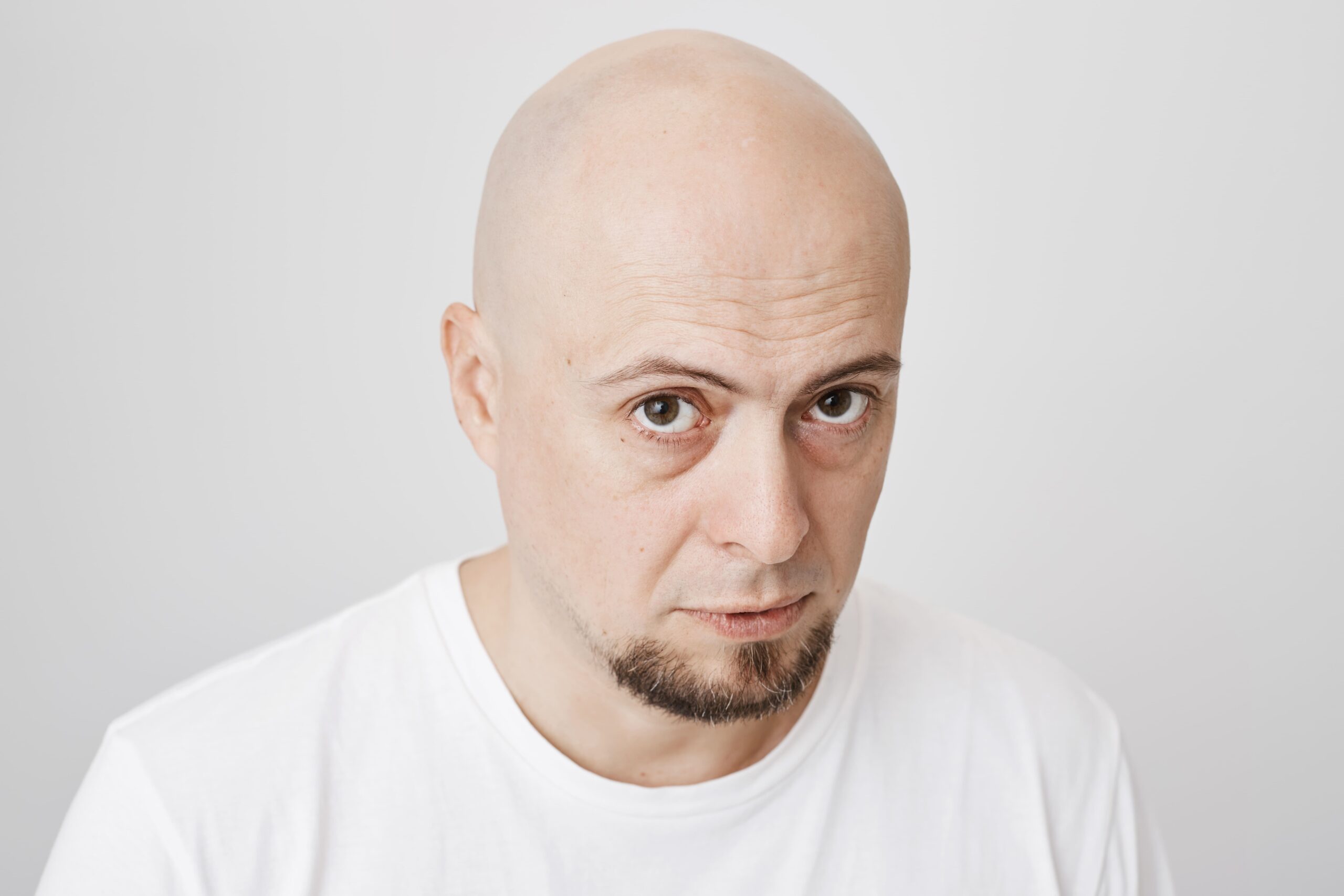Hombre preocupado con alopecia universal