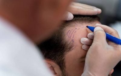 Alopecia Areata: Todo lo que Debes Saber sobre esta Condicción Capilar